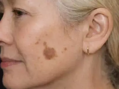 Native ad creative — nomoredarkspot.com (skincare, anti-aging), Outbrain network